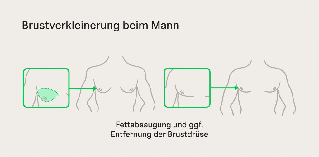 Abbildung der Brustverkleinerung beim Mann