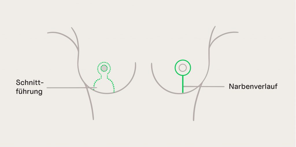 Grafik Schnittführung Bruststraffung