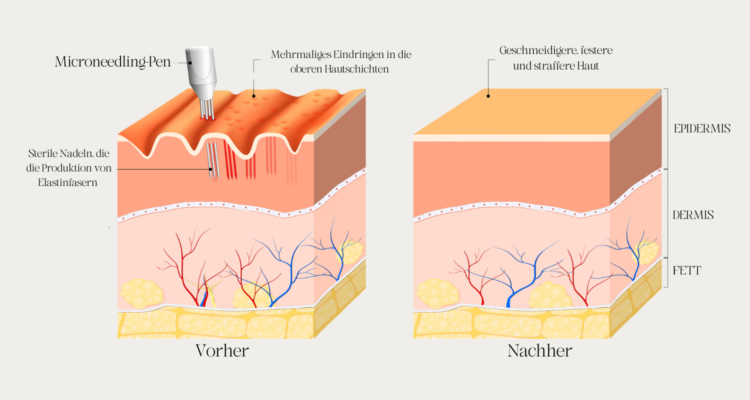 Spannende Microneedling Was Ist Das Fotos